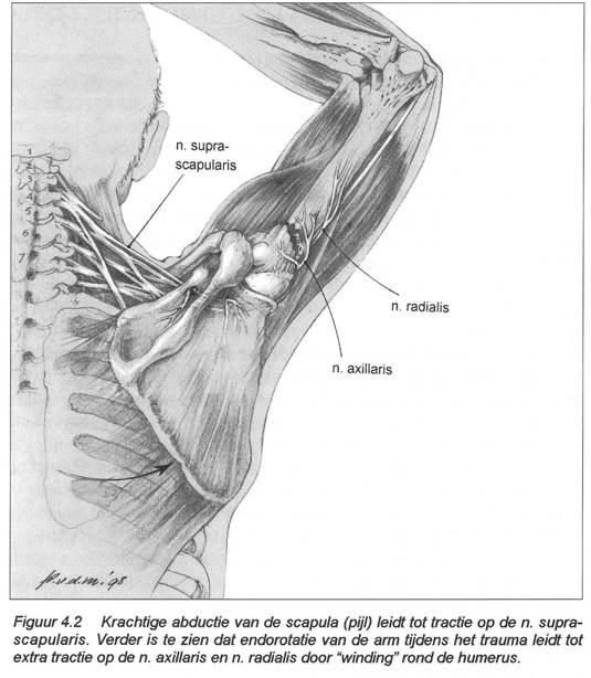 Zenuwletsel bij schouderluxaties 
