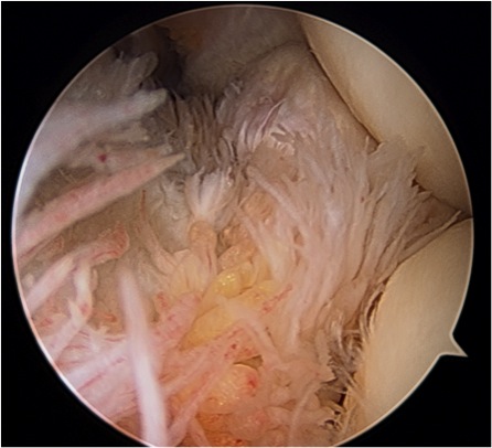 Ontstekingsbeeld in de elleboog (synovitis)