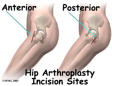 Anterior en Posterior - heupgewricht