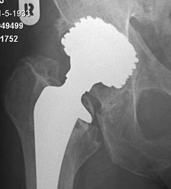 Loslating schroefkom en ongecementeerde heupsteel