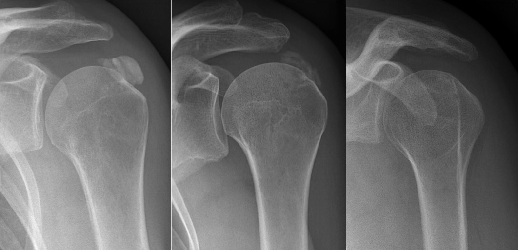 Barbotage kalk calcificatie