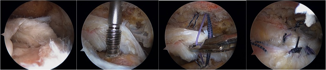 schouder scopische cuff repair