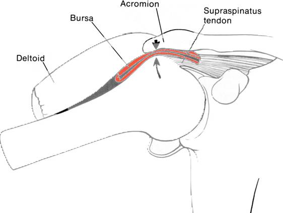 pijnsyndroom (impingement) - Rijnland Orthopaedie