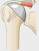 Anatomische schouderprothese