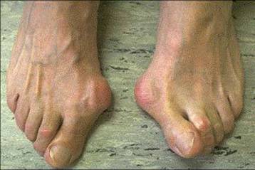 Hallux valgus