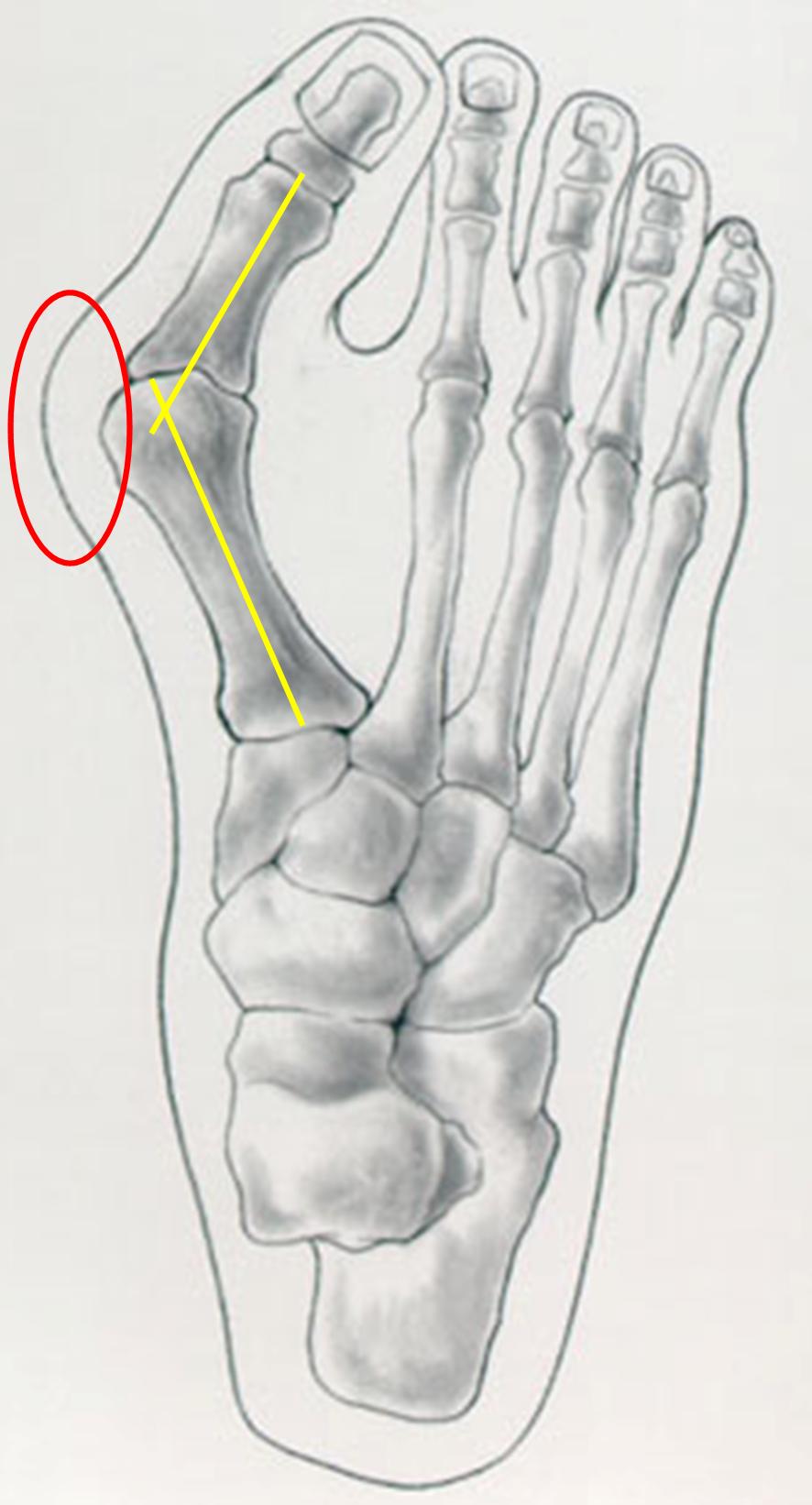 Hallux valgus