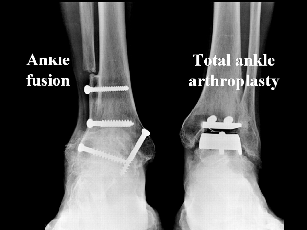 Artrose de enkel (bovenste spronggewricht) Orthopaedie