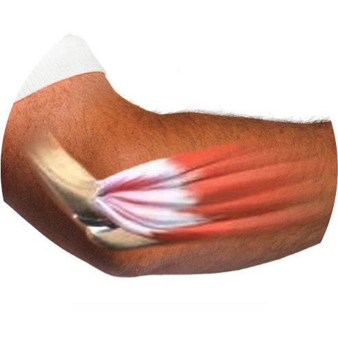 Nieuwe behandeltechniek tenniselleboog