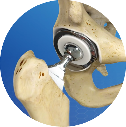 Totale heupprothese in dagbehandeling